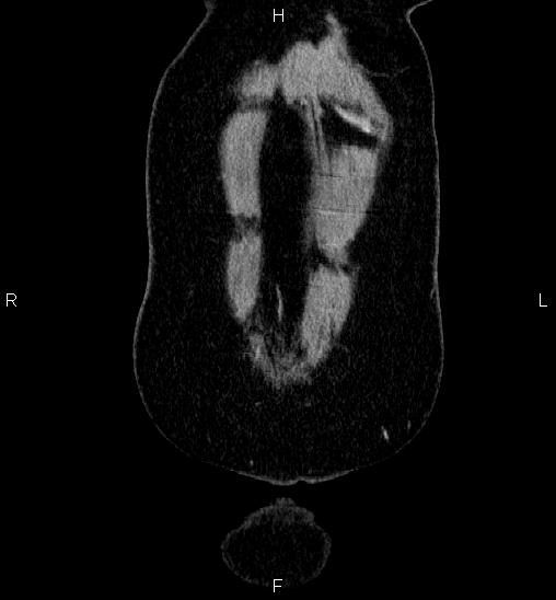 Adrenal cortical carcinoma (Radiopaedia 84882-100379 Coronal C+ portal venous phase 1).jpg