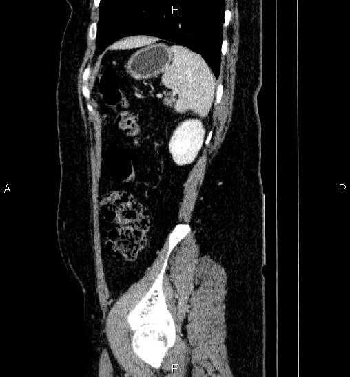 Adrenal cortical carcinoma (Radiopaedia 84882-100379 Sagittal C+ portal venous phase 72).jpg