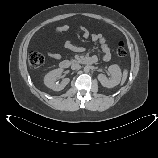 Adrenal cyst (Radiopaedia 45625-49778 Axial non-contrast 47).png