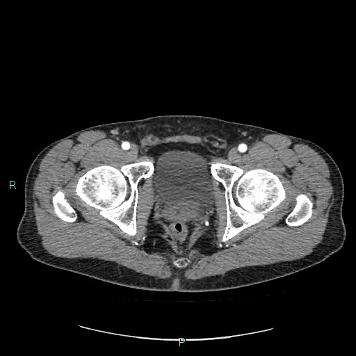 Adrenal cystic lymphangioma (Radiopaedia 83161-97534 Axial C+ arterial phase 96).jpg