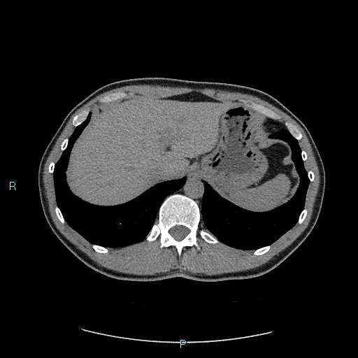 Adrenal cystic lymphangioma (Radiopaedia 83161-97534 Axial non-contrast 20).jpg
