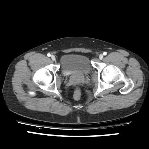 File:Adrenal gland trauma (Radiopaedia 81351-95078 Axial Dual bolus trauma C+ 117).jpg