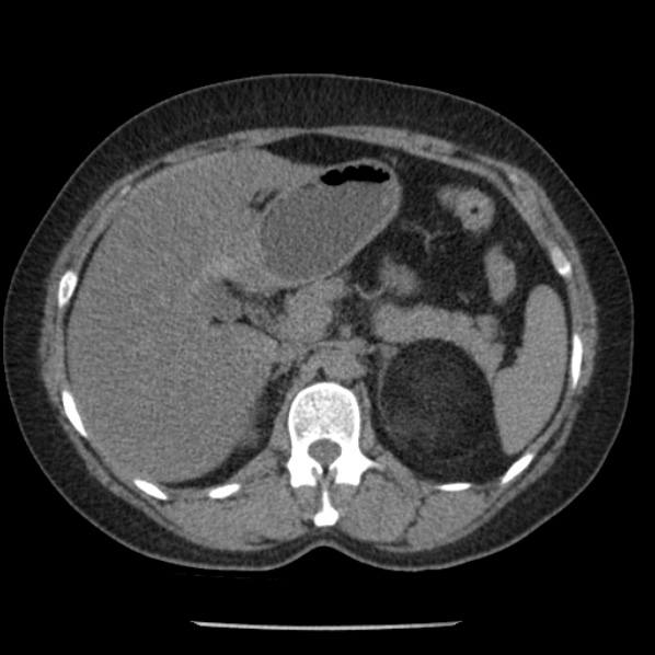 File:Adrenal myelolipoma (Radiopaedia 43401-46759 Axial non-contrast 27).jpg