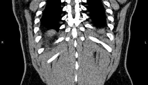 Adrenal myelolipoma (Radiopaedia 84321-99619 Coronal non-contrast 70).jpg