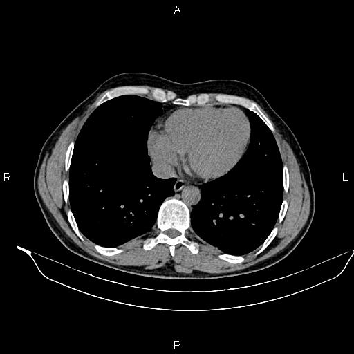 Adrenal myelolipoma (Radiopaedia 87794-104246 Axial non-contrast 8).jpg