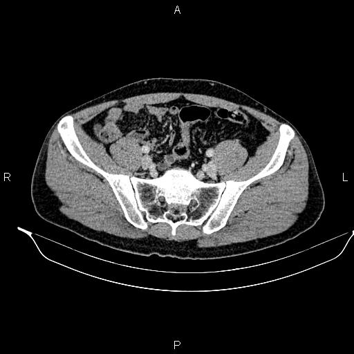 File:Adrenal myelolipoma (Radiopaedia 87794-104246 Axial renal cortical phase 83).jpg