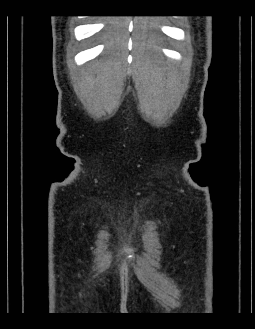Adrenal myelolipoma - bilateral (Radiopaedia 74805-85810 Coronal C+ portal venous phase 45).jpg