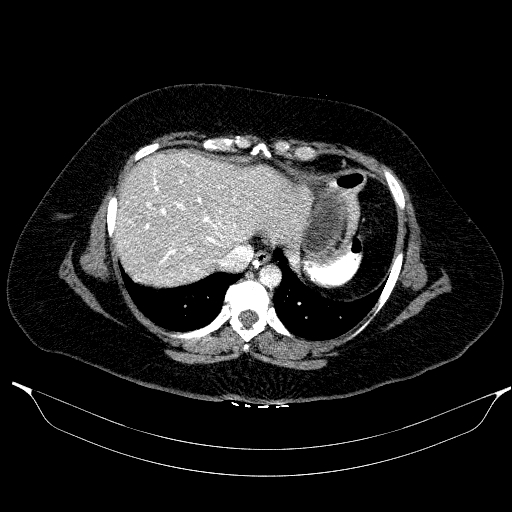 File:Afferent loop syndrome - secondary to incarcerated trocar site hernia (Radiopaedia 82959-97305 Axial C+ portal venous phase 30).jpg