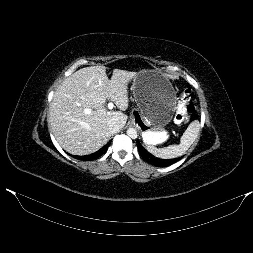 Afferent loop syndrome - secondary to incarcerated trocar site hernia (Radiopaedia 82959-97305 Axial C+ portal venous phase 53).jpg