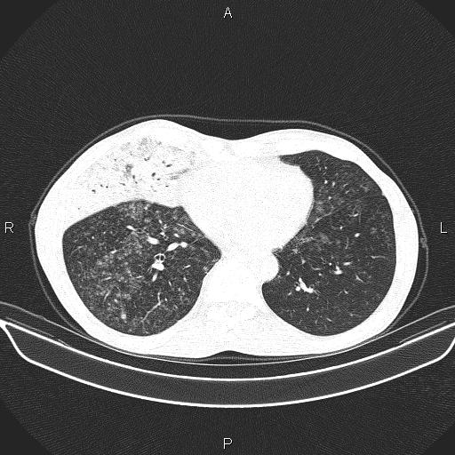 Air bronchogram in pneumonia (Radiopaedia 85719-101512 Axial lung window 47).jpg