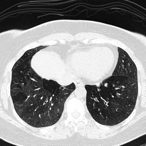 Air trapping in small airway disease (Radiopaedia 61685-69694 Axial lung window 135).jpg