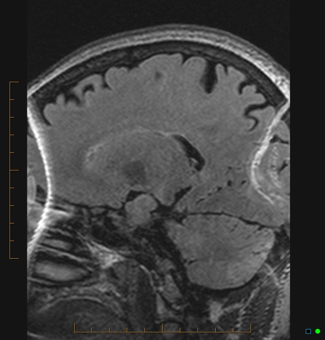 Aliasing artifact causing a spurious cerebellar lesion (Radiopaedia 48783-53810 Sagittal FLAIR 71).jpg