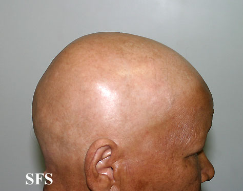 Alopecia Areata (Dermatology Atlas 27).jpg