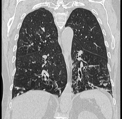 Alpha-1-antitrypsin deficiency (Radiopaedia 72058-82557 Coronal lung window 59).jpg