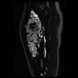Alveolar soft part sarcoma (Radiopaedia 64501-73678 D 75).jpg