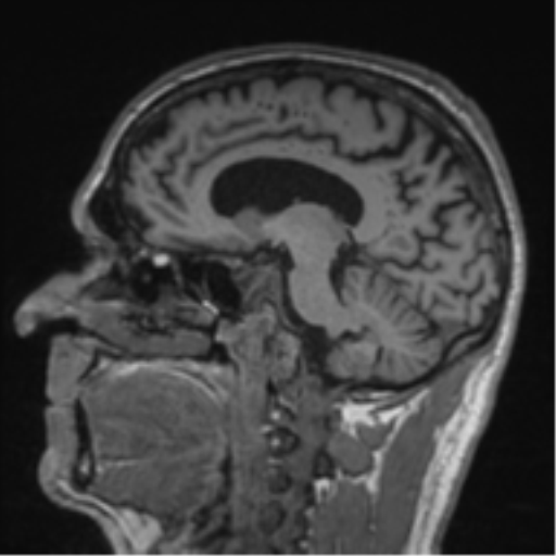 Alzheimer's disease- with Gerstmann syndrome and dressing apraxia (Radiopaedia 54882-61150 Sagittal T1 30).png