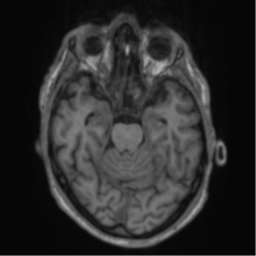 Alzheimer's disease- with apraxia (Radiopaedia 54763-61011 Axial T1 27).png