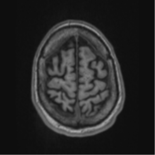 Alzheimer's disease- with apraxia (Radiopaedia 54763-61011 Axial T1 65).png
