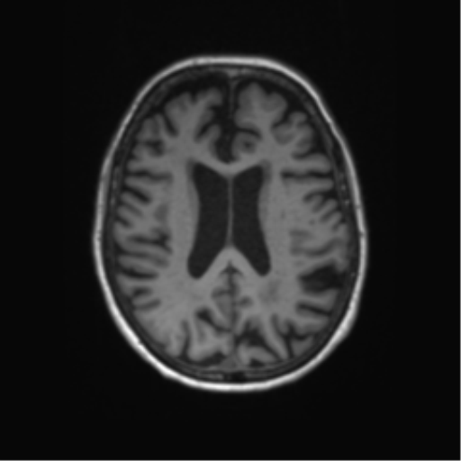 File:Alzheimer's disease (Radiopaedia 42658-45802 Axial T1 63).png