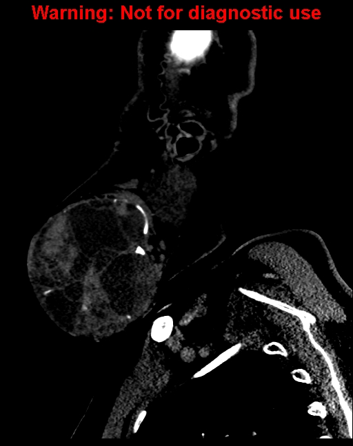 Ameloblastoma (Radiopaedia 33126-34164 F 12).jpg