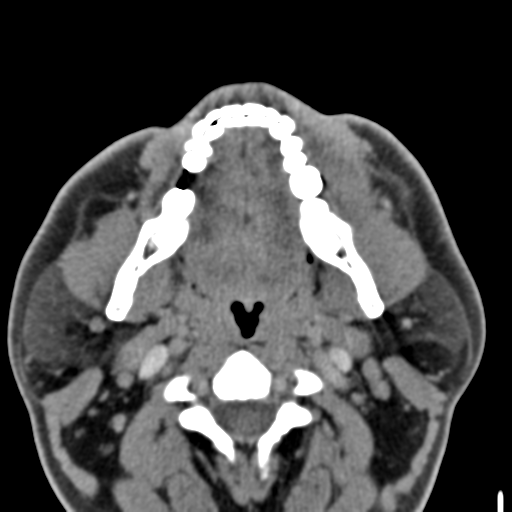 File:Ameloblastoma (Radiopaedia 33677-34806 Axial non-contrast 20).png