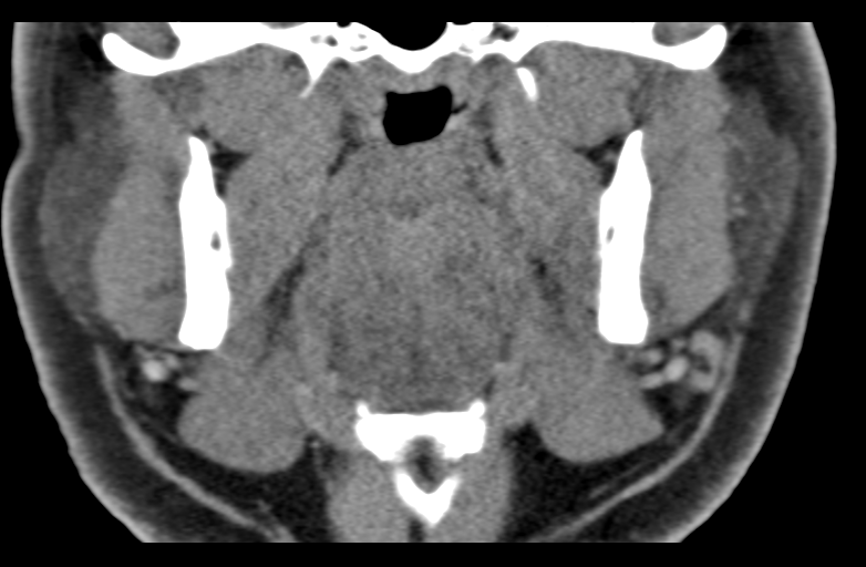 File:Ameloblastoma (Radiopaedia 33677-34806 Coronal non-contrast 34).png