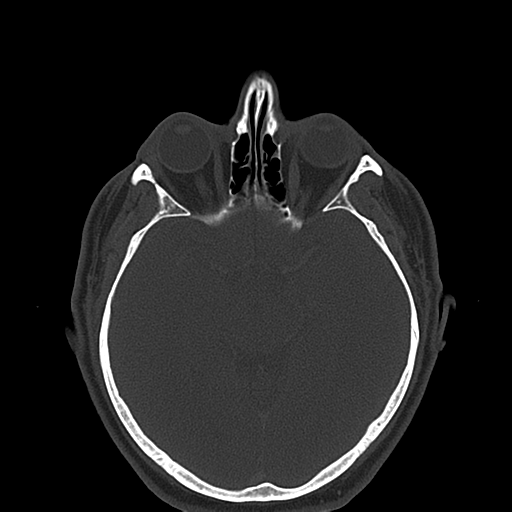 Ameloblastoma (Radiopaedia 38520-40623 Axial bone window 3).png