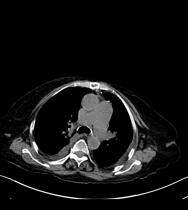 Amiodarone deposition in the liver (Radiopaedia 77587-89780 Axial non-contrast 31).jpg