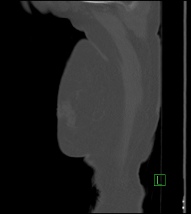 Amiodarone deposition in the liver (Radiopaedia 77587-89780 Sagittal bone window 97).jpg