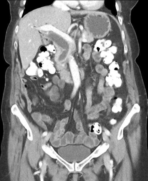 Ampullary adenocarcinoma (Radiopaedia 34013-35237 E 23).png