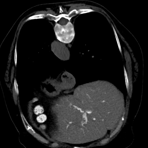 Ampullary adenocarcinoma (Radiopaedia 34013-35241 C 17).png