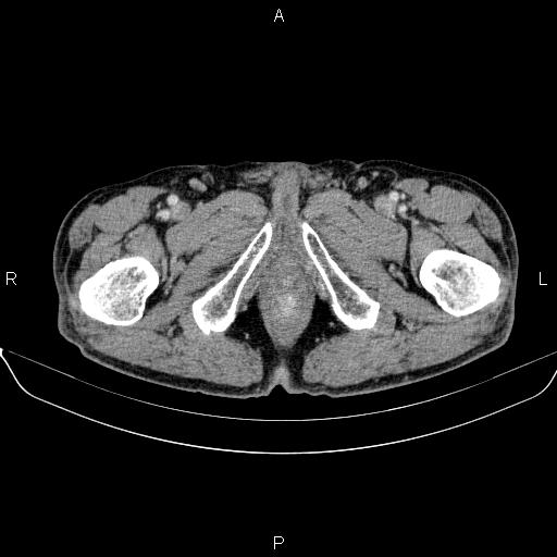Ampullary adenocarcinoma (Radiopaedia 86093-102032 A 60).jpg