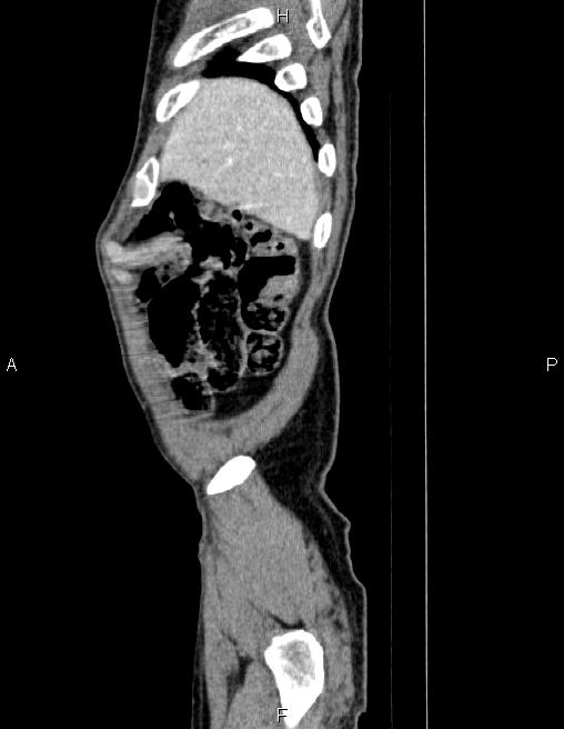 Ampullary adenocarcinoma (Radiopaedia 86093-102032 D 5).jpg