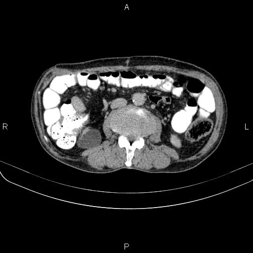 Ampullary adenocarcinoma (Radiopaedia 86093-102033 Axial C+ delayed 65).jpg