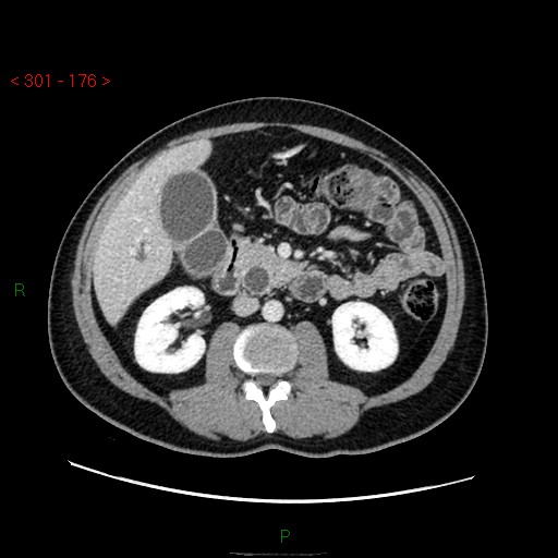 Ampullary carcinoma (Radiopaedia 56396-63056 C 45).jpg