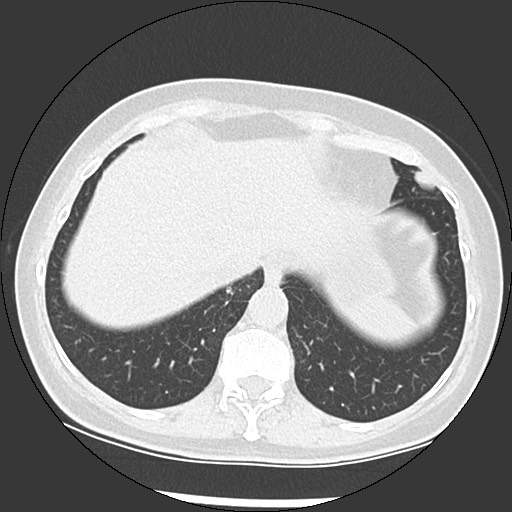Amyloidosis - bronchial and diffuse nodular pulmonary involvement (Radiopaedia 60156-67744 B 48).jpg