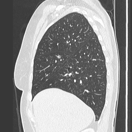 Amyloidosis - bronchial and diffuse nodular pulmonary involvement (Radiopaedia 60156-67745 Sagittal lung window 22).jpg