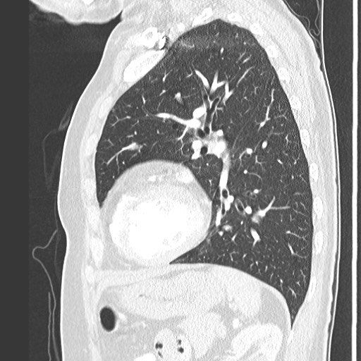 Amyloidosis - bronchial and diffuse nodular pulmonary involvement (Radiopaedia 60156-67745 Sagittal lung window 63).jpg
