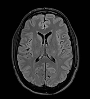 File:Amyotrophic lateral sclerosis (Radiopaedia 87352-103658 Axial FLAIR 17).jpg
