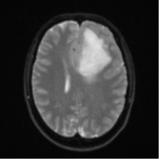 Anaplastic astrocytoma (Radiopaedia 57768-64731 Axial DWI 18).png