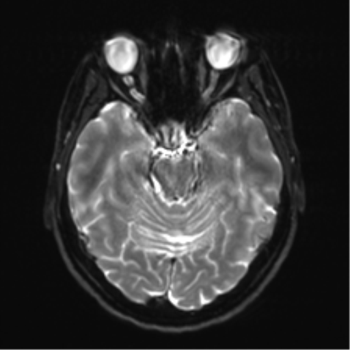Anaplastic astrocytoma - thalamic glioma (Radiopaedia 59709-67115 Axial DWI 12).png