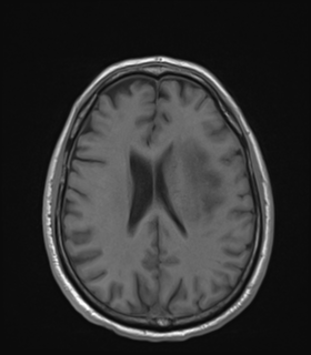 Anaplastic astrocytoma IDH wild-type (Radiopaedia 49984-55273 Axial T1 37).png