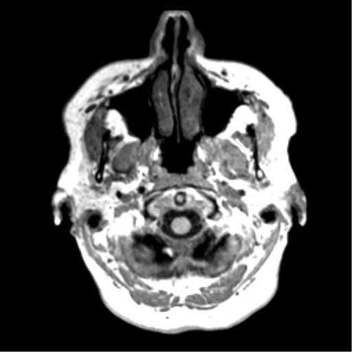File:Anaplastic astrocytoma IDH wild-type (pseudoprogression) (Radiopaedia 42209-45277 Axial T1 5).png