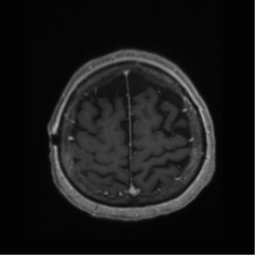 File:Anaplastic astrocytoma IDH wild-type (pseudoprogression) (Radiopaedia 42209-45277 Axial T1 C+ 107).png