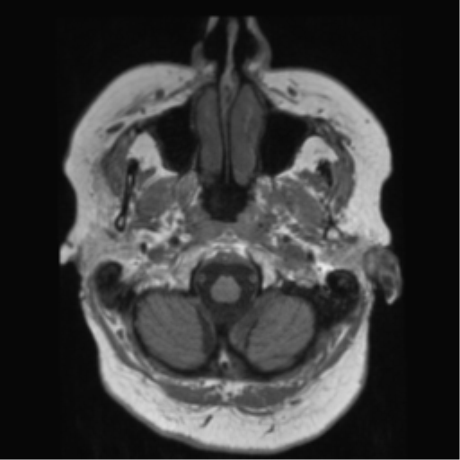 File:Anaplastic astrocytoma IDH wild-type (pseudoprogression) (Radiopaedia 42209-45278 Axial T1 25).png