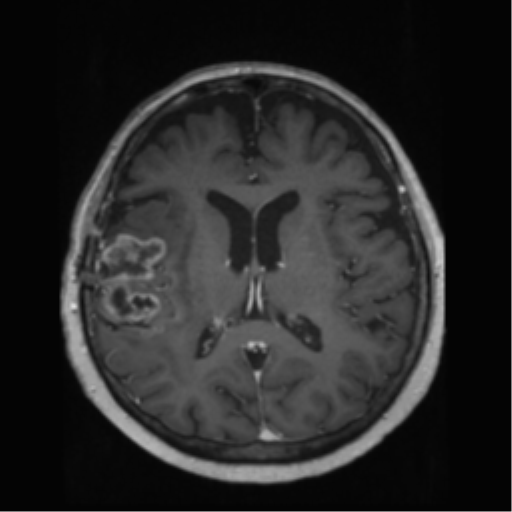 File:Anaplastic astrocytoma IDH wild-type (pseudoprogression) (Radiopaedia 42209-45278 Axial T1 C+ 90).png