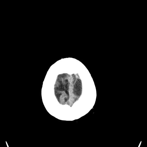 File:Anaplastic meningioma with recurrence (Radiopaedia 34452-35781 Axial non-contrast 32).png