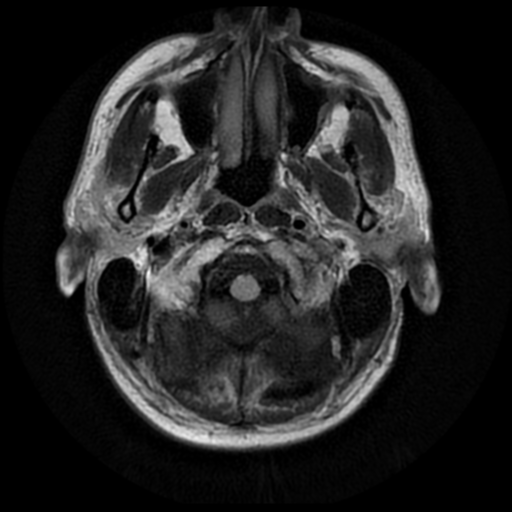 File:Anaplastic meningioma with recurrence (Radiopaedia 34452-35791 Axial FLAIR 1).png