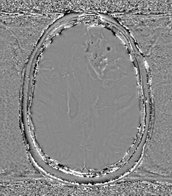 Anaplastic oligodendroglioma (Radiopaedia 83500-98599 Axial SWI - phase 56).png