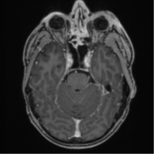 Anaplastic oligodendroglioma with skull fracture (Radiopaedia 74831-85845 Axial T1 C+ fat sat 18).png